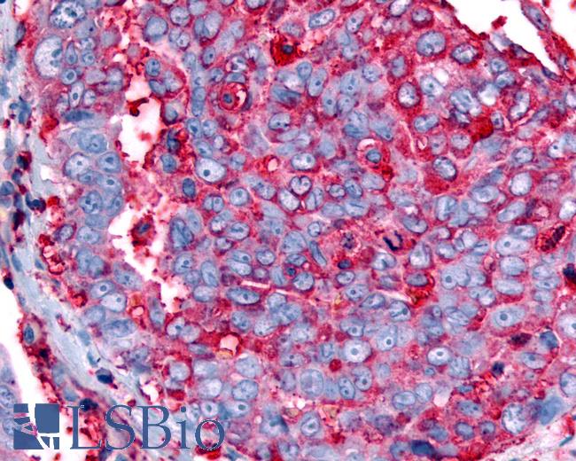 Anti-GPR63 antibody IHC of human Ovary, Carcinoma. Immunohistochemistry of formalin-fixed, paraffin-embedded tissue after heat-induced antigen retrieval.