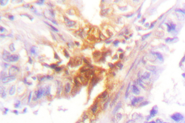 IHC of IL-2R (T360) pAb in paraffin-embedded human lung carcinoma tissue.