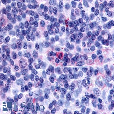 Anti-GPR65 antibody LS-A1627 IHC of human lymph node, Hodgkin's disease. Immunohistochemistry of formalin-fixed, paraffin-embedded tissue after heat-induced antigen retrieval.