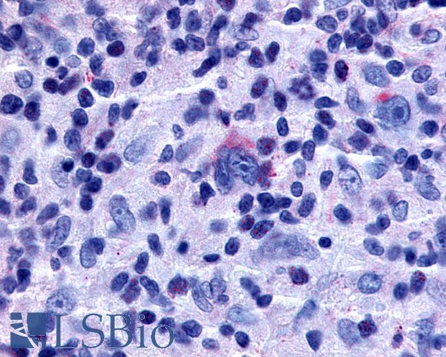 Anti-GPR65 / TDAG8 antibody IHC of human Lymph Node, Hodgkins Lymphoma. Immunohistochemistry of formalin-fixed, paraffin-embedded tissue after heat-induced antigen retrieval.