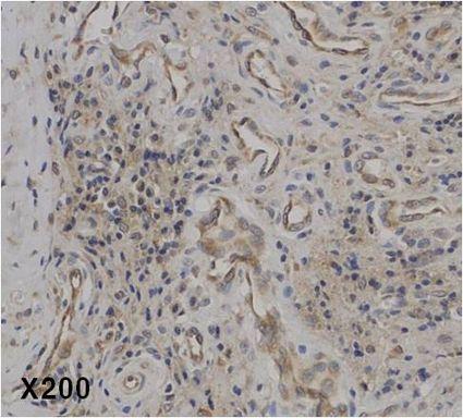 Immunohistochemical staining of IL-37 in human rheumatoid arthritis tissue. . Method: Immunohistochemical analysis of a paraffin-embedded rheumatoid arthritis tissue, showing endothelial cells and plasma cells (mature B cells) stained by anti-IL-37 at dilution 1:50 (under X200 lens, Brown color).