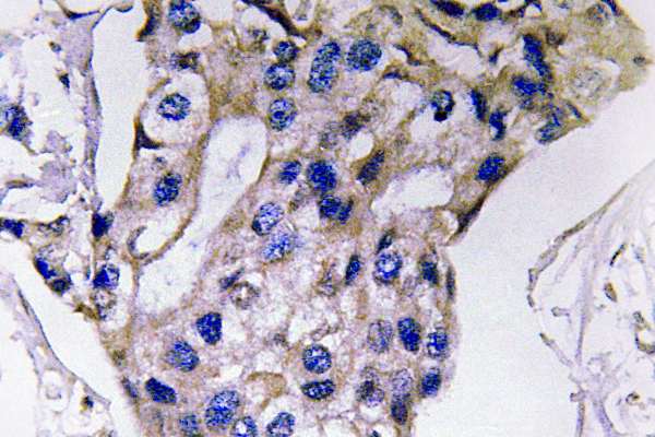 IHC of IL-5 (S92) pAb in paraffin-embedded human breast carcinoma tissue.
