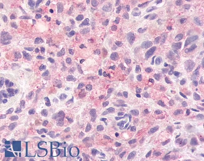 Anti-GPR78 antibody IHC of human Skin, Melanoma. Immunohistochemistry of formalin-fixed, paraffin-embedded tissue after heat-induced antigen retrieval.