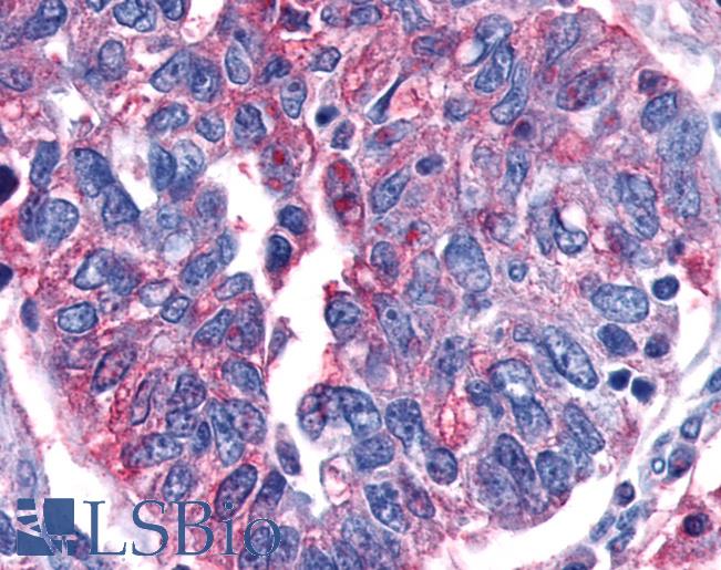 Anti-GPR80 / GPR99 / OXGR1 antibody IHC of human Ovary, Carcinoma. Immunohistochemistry of formalin-fixed, paraffin-embedded tissue after heat-induced antigen retrieval.