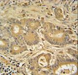 IMMT Antibody immunohistochemistry of formalin-fixed and paraffin-embedded human colon carcinoma followed by peroxidase-conjugated secondary antibody and DAB staining.