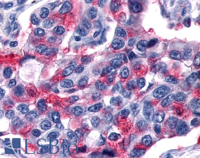 Anti-GPR80 / GPR99 / OXGR1 antibody IHC of human Lung, Non-Small Cell Carcinoma. Immunohistochemistry of formalin-fixed, paraffin-embedded tissue after heat-induced antigen retrieval.