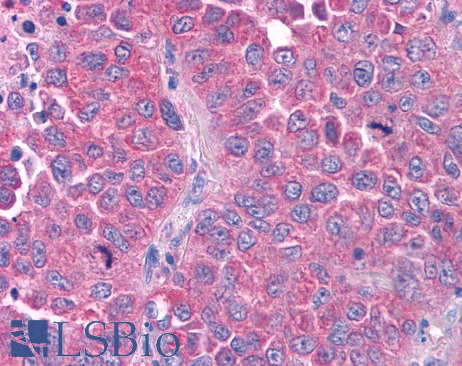 Anti-GPR80 / GPR99 / OXGR1 antibody IHC of human Lung, Non-Small Cell Carcinoma. Immunohistochemistry of formalin-fixed, paraffin-embedded tissue after heat-induced antigen retrieval.