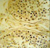 IMP4 Antibody IHC of formalin-fixed and paraffin-embedded human testis carcinoma followed by peroxidase-conjugated secondary antibody and DAB staining.