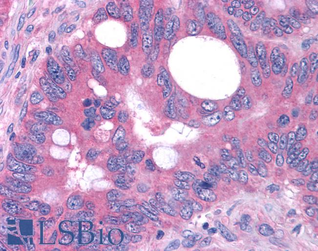 Anti-GPR80 / GPR99 / OXGR1 antibody IHC of human Colon, Carcinoma. Immunohistochemistry of formalin-fixed, paraffin-embedded tissue after heat-induced antigen retrieval.