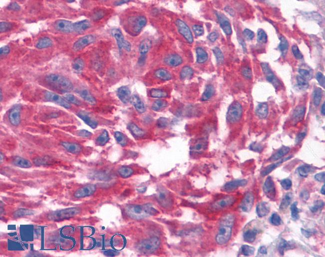 Anti-GPR80 / GPR99 / OXGR1 antibody IHC of human Skin, Melanoma. Immunohistochemistry of formalin-fixed, paraffin-embedded tissue after heat-induced antigen retrieval.
