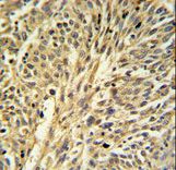IMPDH2 Antibody IHC of formalin-fixed and paraffin-embedded human Lung carcinoma followed by peroxidase-conjugated secondary antibody and DAB staining.