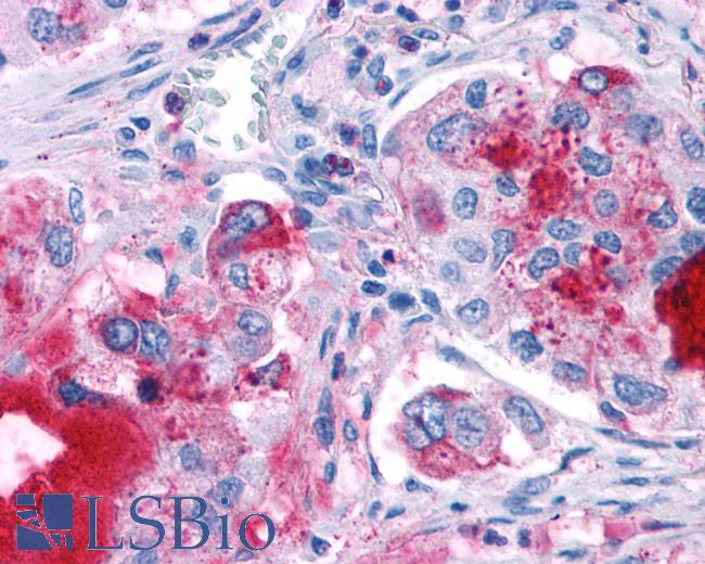 Anti-GPR82 antibody IHC of human Lung, Adenocarcinoma. Immunohistochemistry of formalin-fixed, paraffin-embedded tissue after heat-induced antigen retrieval.