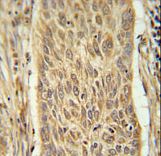 INMT Antibody immunohistochemistry of formalin-fixed and paraffin-embedded human lung carcinoma followed by peroxidase-conjugated secondary antibody and DAB staining.
