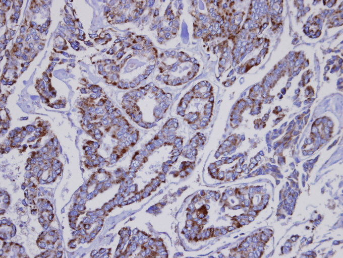 IHC of paraffin-embedded Thyroid gland tumor using INPP1 antibody at 1:100 dilution.