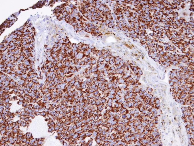 IHC of paraffin-embedded Huh7 xenograft using INPP1 antibody at 1:100 dilution.