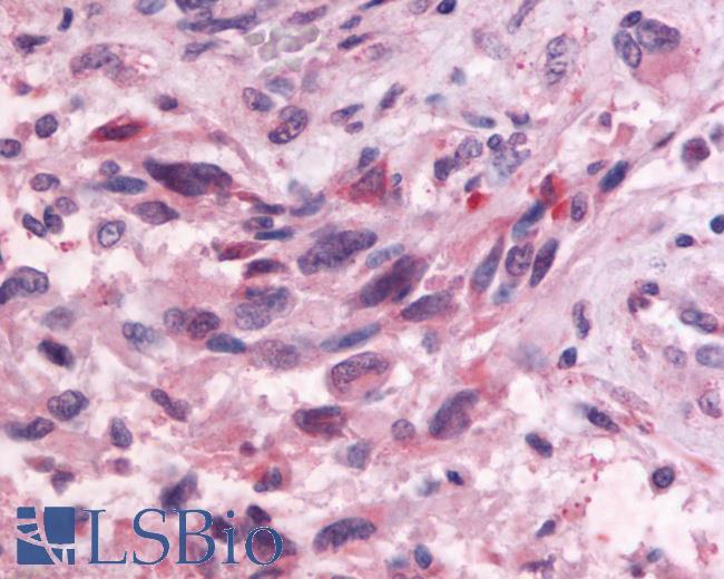 Anti-GPR83 antibody IHC of human Brain, Glioblastoma. Immunohistochemistry of formalin-fixed, paraffin-embedded tissue after heat-induced antigen retrieval.