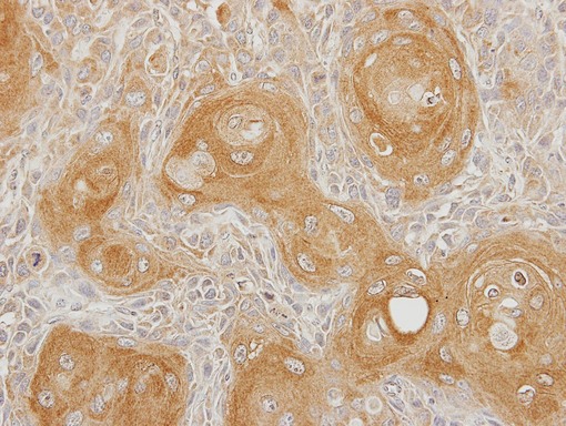 IHC of paraffin-embedded Ca922 xenograft using INPP5B antibody at 1:100 dilution.