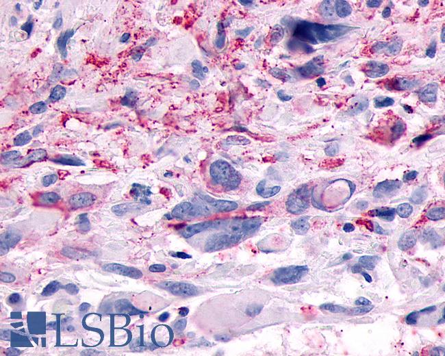 Anti-GPR83 antibody IHC of human Brain, Glioblastoma. Immunohistochemistry of formalin-fixed, paraffin-embedded tissue after heat-induced antigen retrieval.