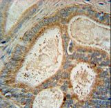 INSIG1 Antibody immunohistochemistry of formalin-fixed and paraffin-embedded human prostate carcinoma followed by peroxidase-conjugated secondary antibody and DAB staining.