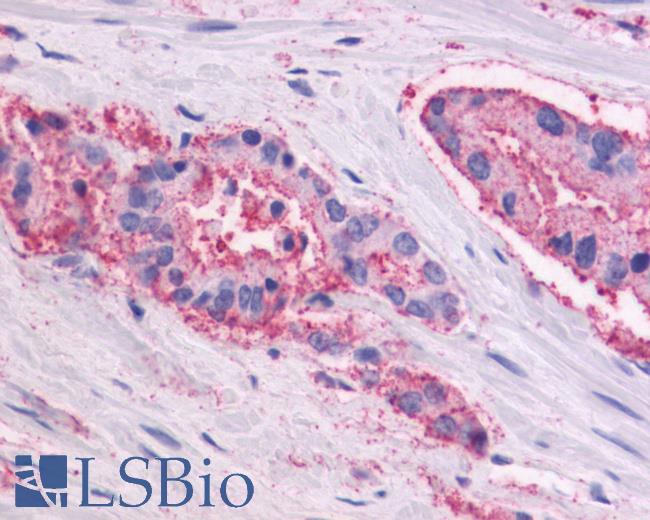 Anti-GPR87 antibody IHC of human Prostate, Carcinoma. Immunohistochemistry of formalin-fixed, paraffin-embedded tissue after heat-induced antigen retrieval.