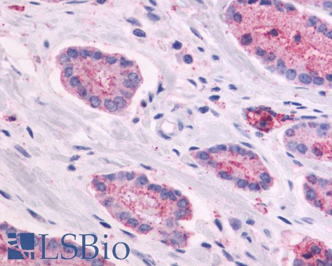 Anti-GPR87 antibody IHC of human Prostate, Carcinoma. Immunohistochemistry of formalin-fixed, paraffin-embedded tissue after heat-induced antigen retrieval.