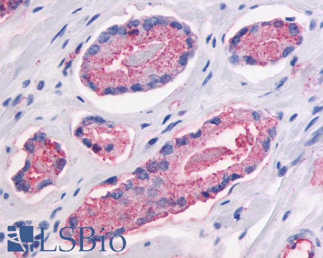 Anti-GPR87 antibody IHC of human Prostate, Carcinoma. Immunohistochemistry of formalin-fixed, paraffin-embedded tissue after heat-induced antigen retrieval.