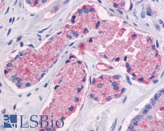 Anti-GPR87 antibody IHC of human Prostate, Carcinoma. Immunohistochemistry of formalin-fixed, paraffin-embedded tissue after heat-induced antigen retrieval.
