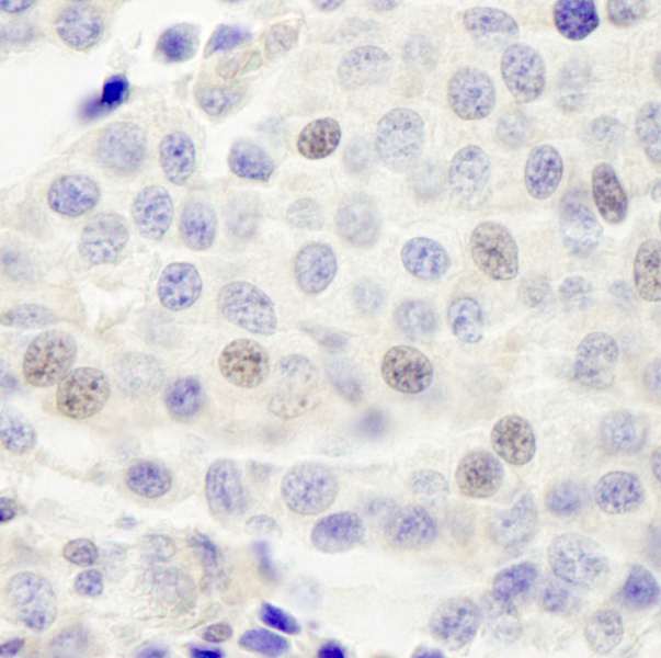 Detection of Human INT4 by Immunohistochemistry. Sample: FFPE section of human breast carcinoma. Antibody: Affinity purified rabbit anti-INT4 used at a dilution of 1:250.