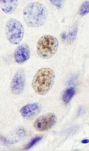 Detection of Human INT4 by Immunohistochemistry. Sample: FFPE section of human breast carcinoma. Antibody: Affinity purified rabbit anti-INT4 used at a dilution of 1:1000 (1 ug/ml). Detection: DAB.