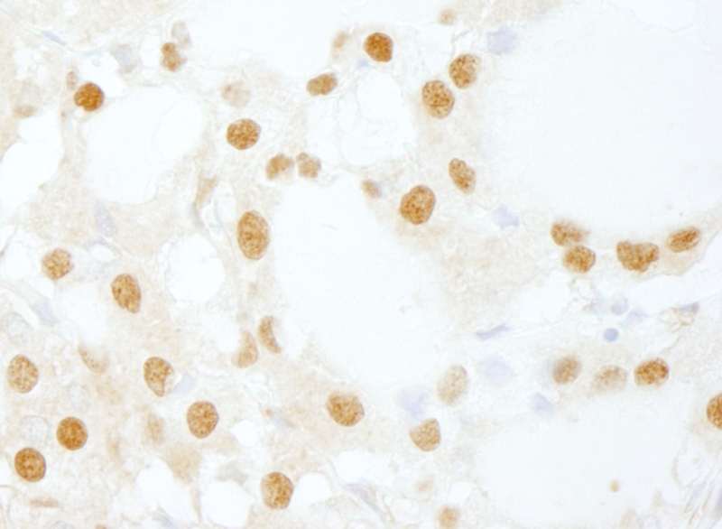 Detection of Human DDX26/DICE1 by Immunohistochemistry. Sample: FFPE section of human thyroid carcinoma. Antibody: Affinity purified rabbit anti-DDX46/DICE1 used at a dilution of 1:200 (1 ug/ml). Detection: DAB.
