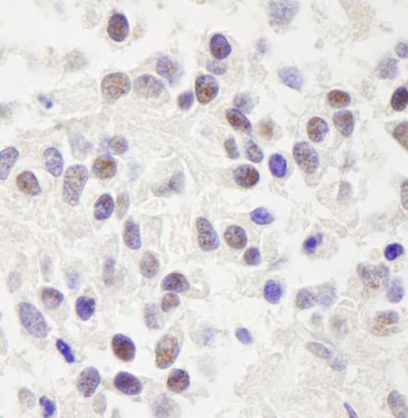 Detection of Human RC74 by Immunohistochemistry. Sample: FFPE section of human Ewing sarcoma. Antibody: Affinity purified rabbit anti-RC74 used at a dilution of 1:1000 (1 ug/ml). Detection: DAB.
