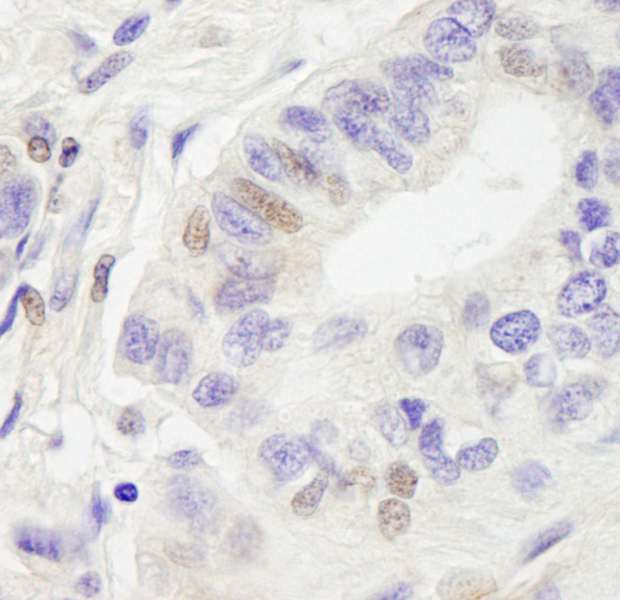 Detection of Human RC74 by Immunohistochemistry. Sample: FFPE section of human ovarian carcinoma. Antibody: Affinity purified rabbit anti-RC74 used at a dilution of 1:5000 (0.2 ug/ml). Detection: DAB.