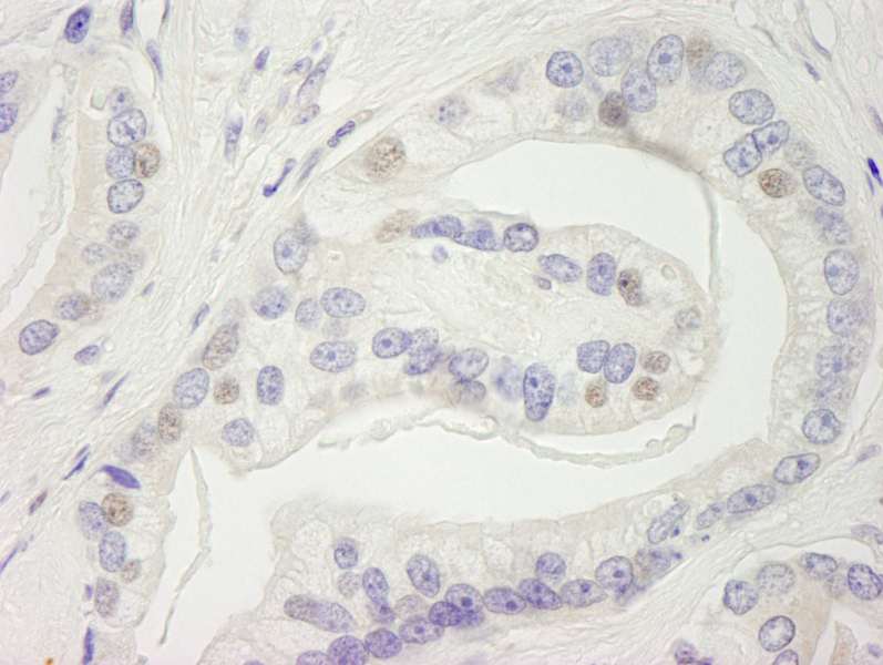 Detection of Human INTS9 by Immunohistochemistry. Sample: FFPE section of human prostate adenocarcinoma. Antibody: Affinity purified rabbit anti-INTS9 used at a dilution of 1:250.