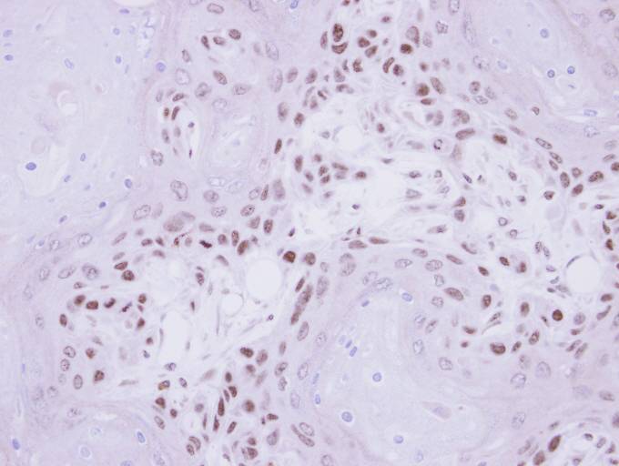IHC of paraffin-embedded Ca922 Xenograft using IP6K1 antibody at 1:500 dilution.
