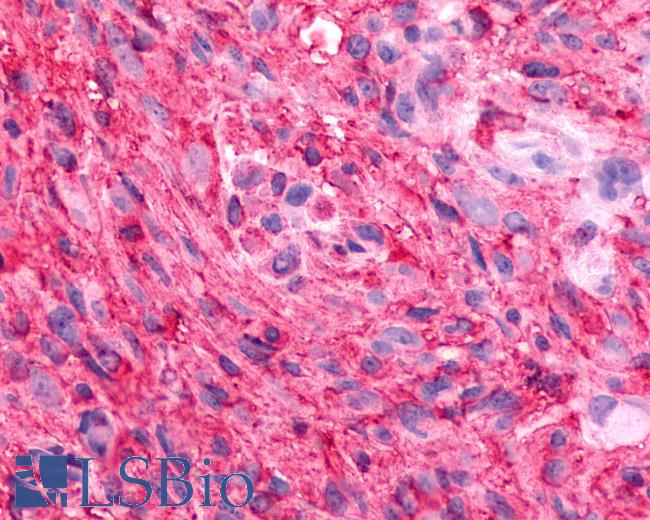 Anti-GPR88 antibody IHC of human Brain, Glioblastoma. Immunohistochemistry of formalin-fixed, paraffin-embedded tissue after heat-induced antigen retrieval.