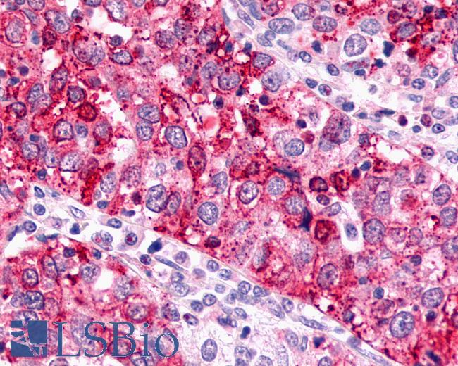 Anti-GPR88 antibody IHC of human Ovary, Carcinoma. Immunohistochemistry of formalin-fixed, paraffin-embedded tissue after heat-induced antigen retrieval.