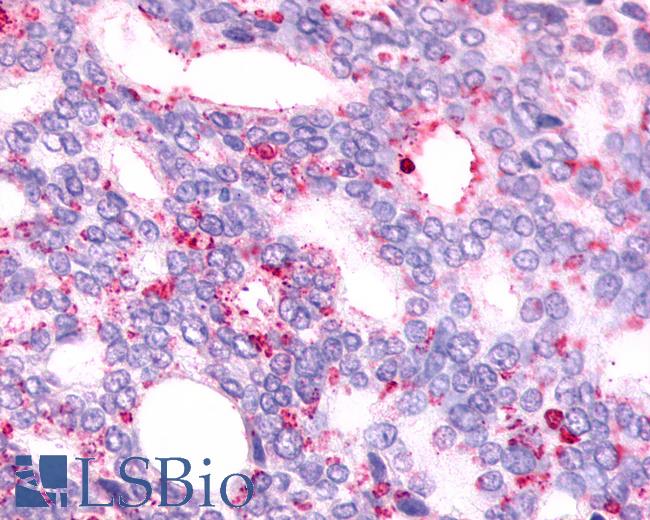 Anti-GPR88 antibody IHC of human Prostate, Carcinoma. Immunohistochemistry of formalin-fixed, paraffin-embedded tissue after heat-induced antigen retrieval.