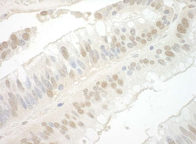 Detection of Human Importin 7 by Immunohistochemistry. Sample: FFPE section of human colon carcinoma. Antibody: Affinity purified rabbit anti-Importin 7 used at a dilution of 1:1000 (0.2 ug/mg).