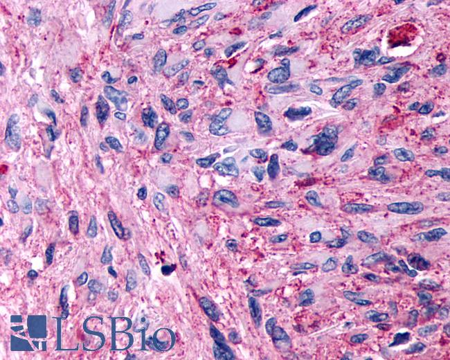 Anti-GPR89A antibody IHC of human Brain, Glioblastoma. Immunohistochemistry of formalin-fixed, paraffin-embedded tissue after heat-induced antigen retrieval.