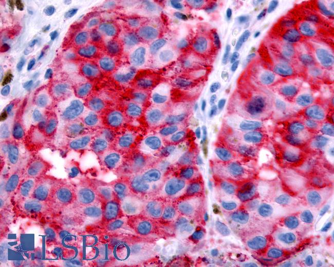 Anti-GPR89A antibody IHC of human Skin, Melanoma. Immunohistochemistry of formalin-fixed, paraffin-embedded tissue after heat-induced antigen retrieval.