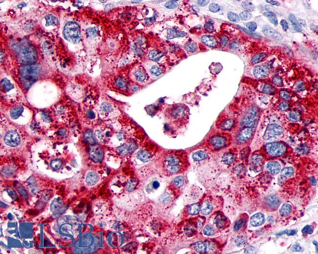 Anti-GPR89A antibody IHC of human Pancreas, Carcinoma. Immunohistochemistry of formalin-fixed, paraffin-embedded tissue after heat-induced antigen retrieval.
