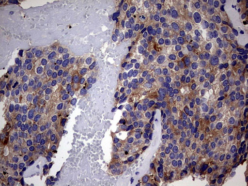 IHC of paraffin-embedded Adenocarcinoma of Human breast tissue using anti-IRAK2 mouse monoclonal antibody. (Heat-induced epitope retrieval by 1 mM EDTA in 10mM Tris, pH8.5, 120°C for 3min).