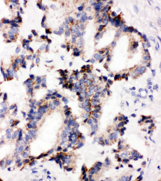 IRAK2 / IRAK-2 antibody. IHC(P): Human Lung Cancer Tissue.