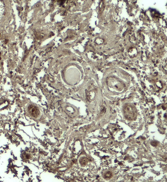 Immunohistochemistry of GPRASP1 in human breast carcinoma tissue with GPRASP12 antibody at 5 ug/ml.