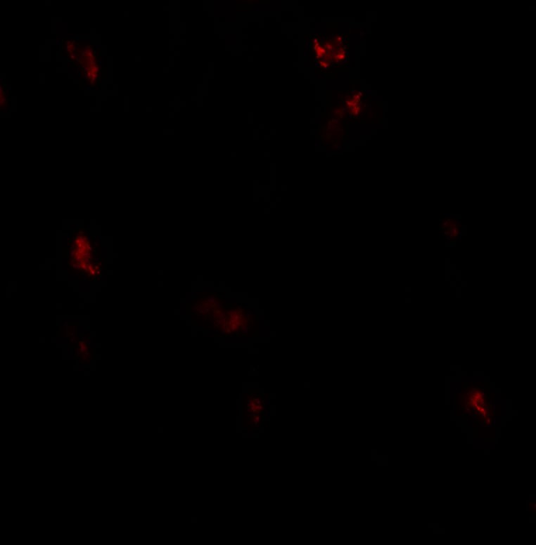 Immunofluorescence of GPRASP1 in human breast carcinoma tissue with GPRASP1 antibody at 20 ug/ml.