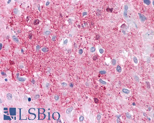 Anti-GPRC5A / RAI3 antibody IHC of human Brain, Glioblastoma. Immunohistochemistry of formalin-fixed, paraffin-embedded tissue after heat-induced antigen retrieval.
