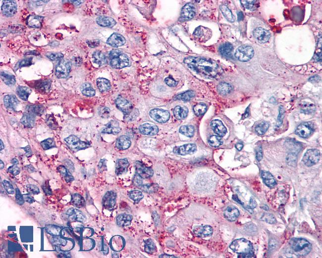 Anti-GPRC5A / RAI3 antibody IHC of human Pancreas, Carcinoma. Immunohistochemistry of formalin-fixed, paraffin-embedded tissue after heat-induced antigen retrieval.