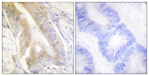 IHC of paraffin-embedded human colon carcinoma tissue, using IREB1 (Ab-138) Antibody. The picture on the right is treated with the synthesized peptide.
