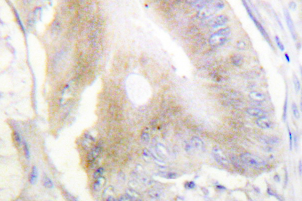 IHC of IRP-1 (R134) pAb in paraffin-embedded human colon carcinoma tissue.