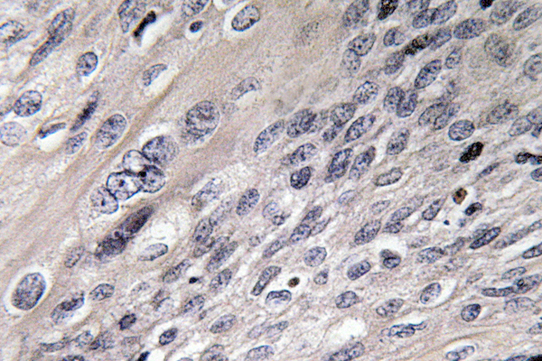 IHC of IRP-1 (N707) pAb in paraffin-embedded human cervix carcinoma tissue.